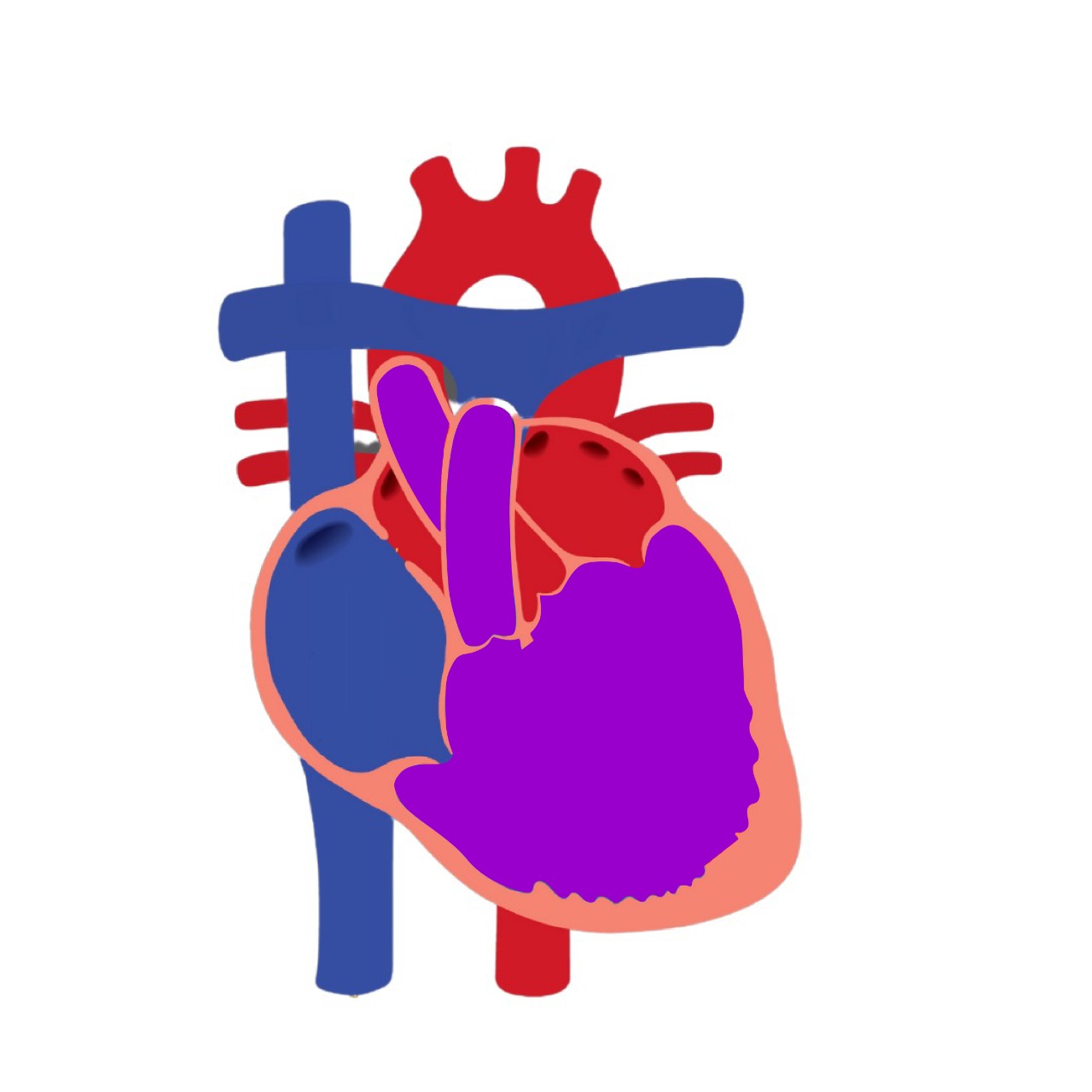 coracao univentricular