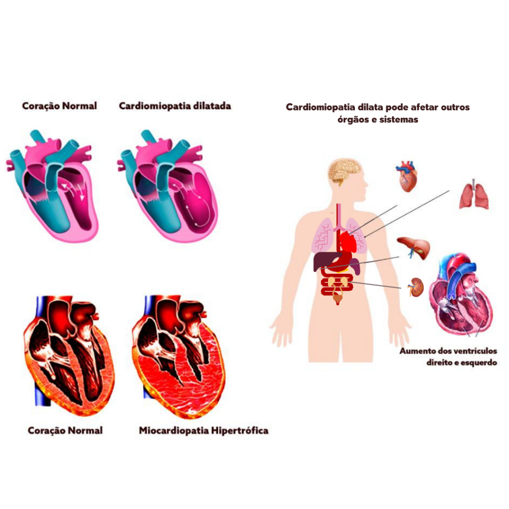 Miocardiopatias - Anvily
